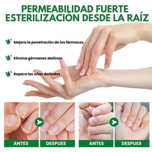 Elimina el hongo de tus Uñas (50ml)