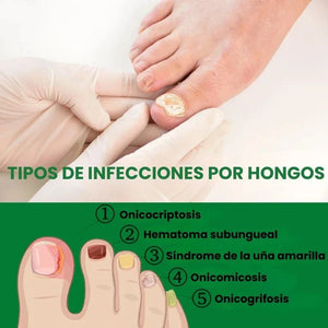 Elimina el hongo de tus Uñas (50ml)